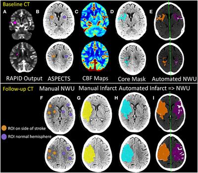 Automated Measurement of Net Water Uptake From Baseline and Follow-Up CTs in Patients With Large Vessel Occlusion Stroke